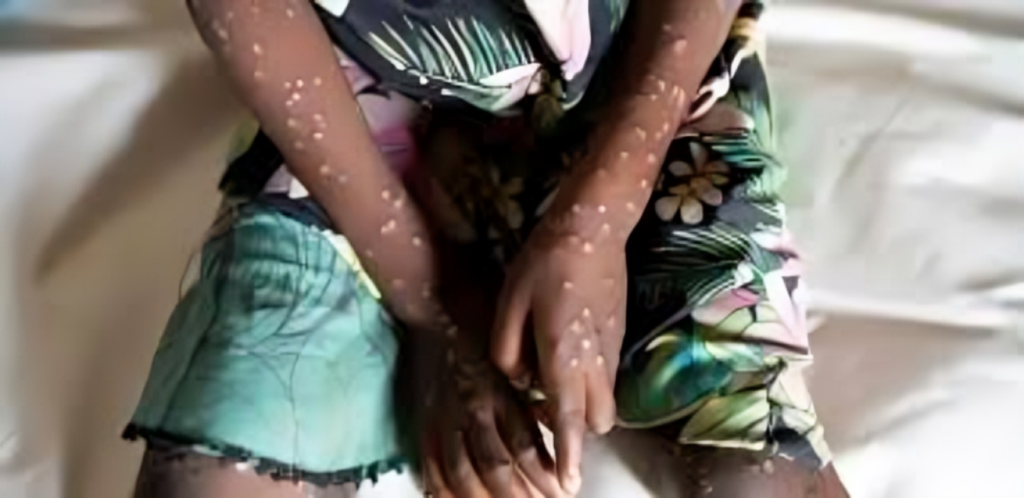 Gambia Declares Mpox Outbreak 1753253162 Gambia Declares Mpox Outbreak