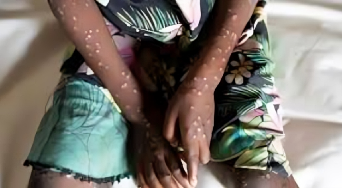 Gambia Declares Mpox Outbreak