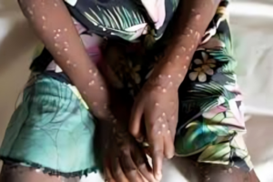 Gambia Declares Mpox Outbreak