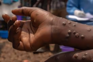 Ghana Records First Mpox Fatality Amid Sharp Rise in Infections