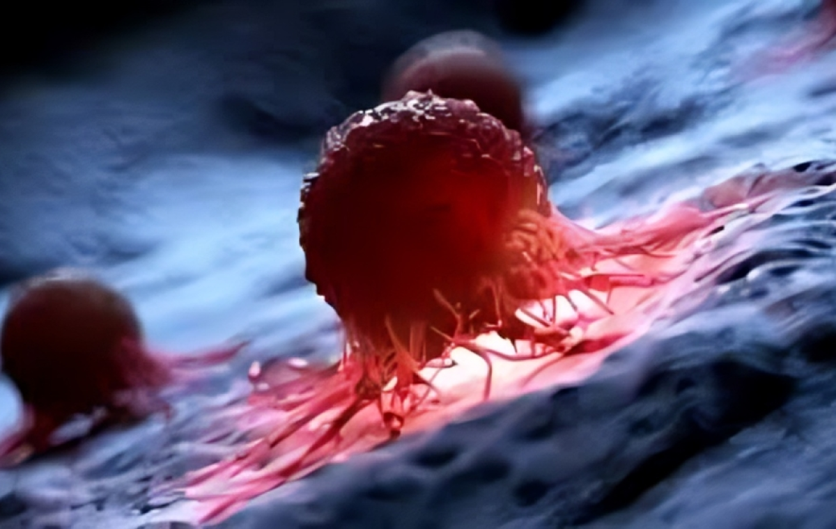 Liver Cancer Cases May Double by 2050, But Most Are Preventable: Study