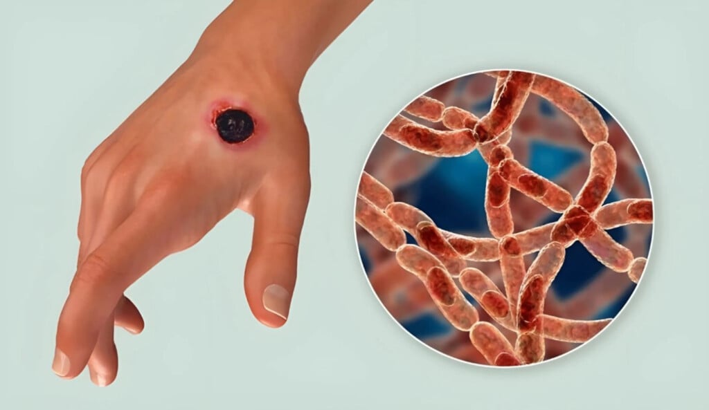 anthrax detected in three more individuals Anthrax Detected in Three More Individuals