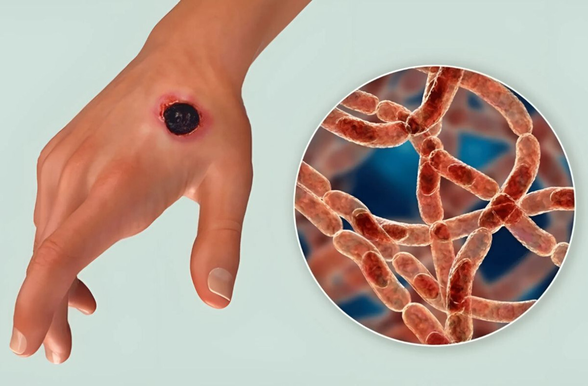 Anthrax Detected in Three More Individuals