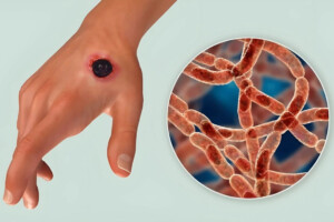 Anthrax Detected in Three More Individuals