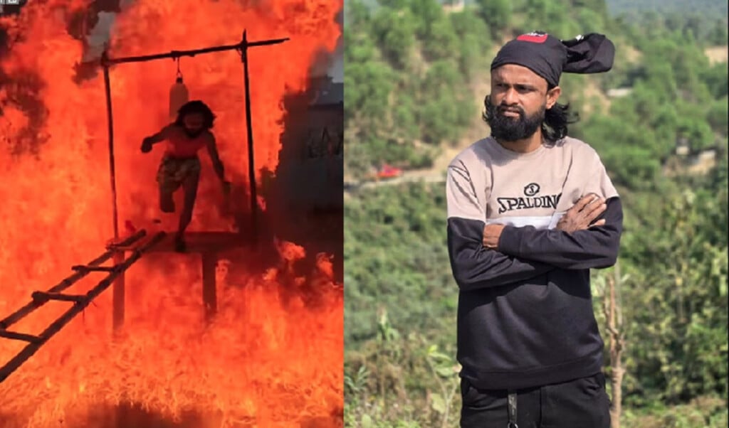 burnt during petrol stunt al amin now in birdem Burnt during petrol stunt, Al Amin now in BIRDEM