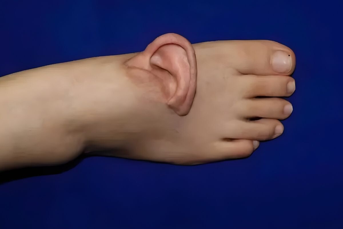 Chinese doctors reattached a severed ear, which had been preserved on the sole of the foot, back onto the head