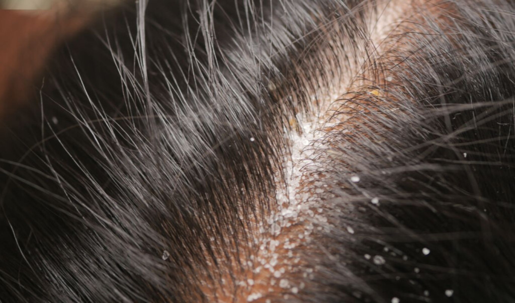 daily habits responsible for dandruff and hair fall Daily Habits Responsible for Dandruff and Hair Fall
