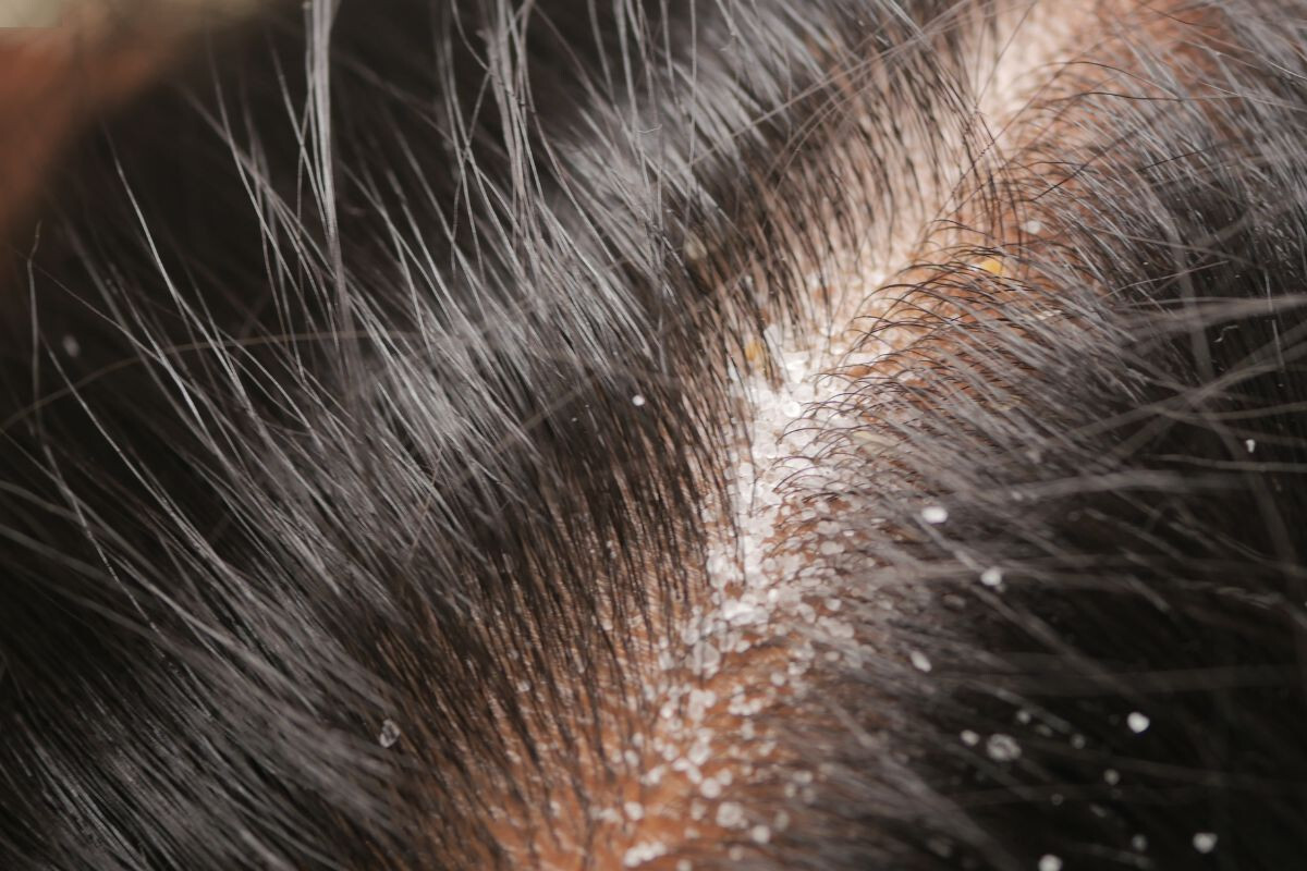 Daily Habits Responsible for Dandruff and Hair Fall