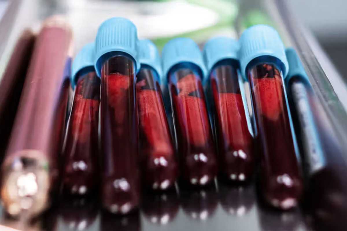 Liquid Biopsy Offers Hope in Advanced Breast Cancer