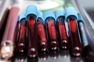 Liquid Biopsy Offers Hope in Advanced Breast Cancer