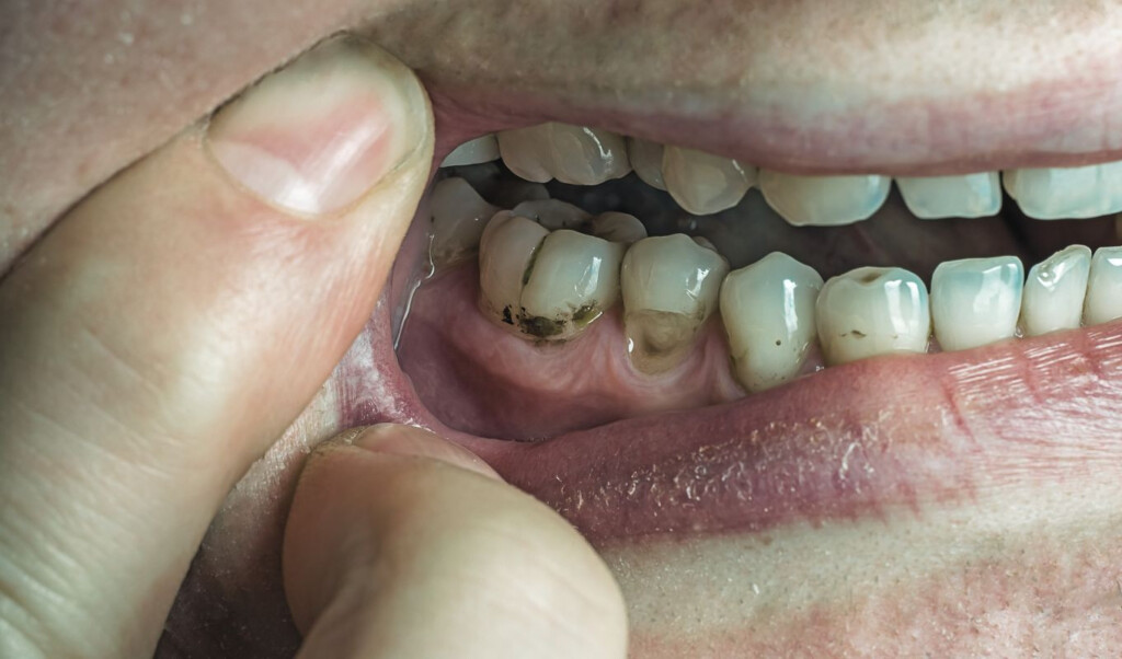 six common foods and drinks that damage tooth enamel Six Common Foods and Drinks That Damage Tooth Enamel