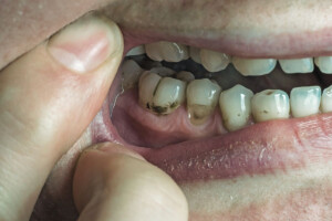 Six Common Foods and Drinks That Damage Tooth Enamel