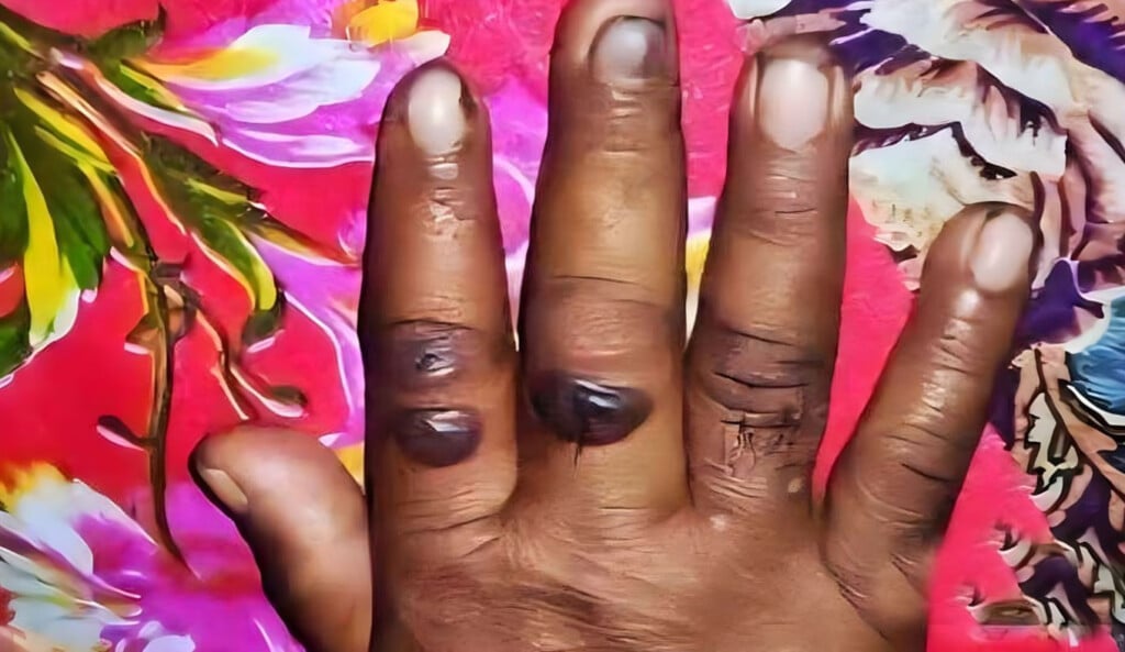 woman dies showing symptoms of anthrax in gaibandha Woman Dies Showing Symptoms of Anthrax in Gaibandha