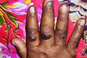 Woman Dies Showing Symptoms of Anthrax in Gaibandha