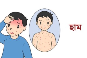 Chittagong to Vaccinate 300,000 Children Against Measles-Rubella