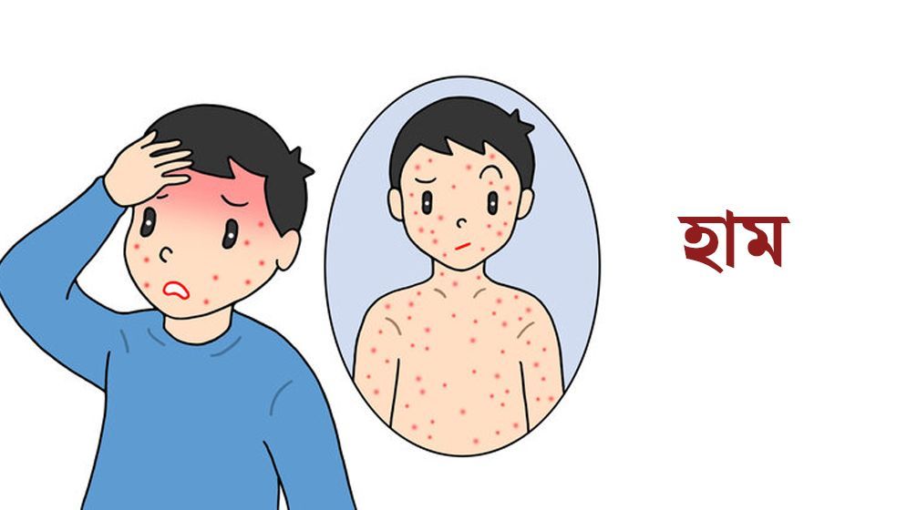 Chittagong to Vaccinate 300,000 Children Against Measles-Rubella