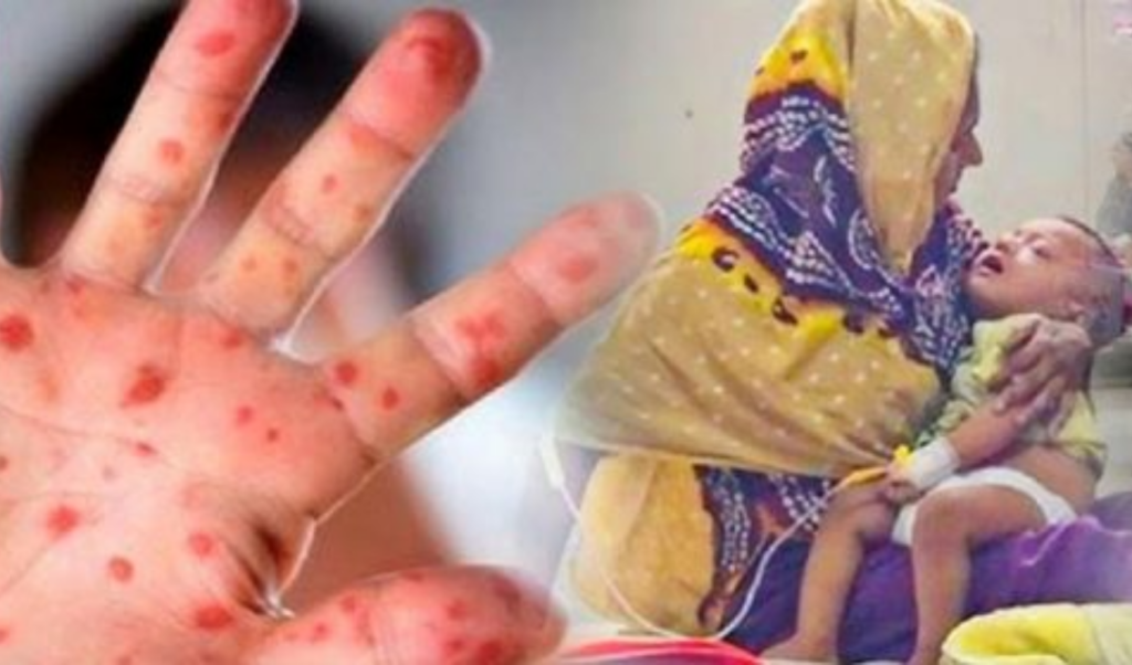 Measles Outbreak Escalates In Cumilla As Infant Dies Measles Outbreak Escalates In Cumilla As Infant Dies