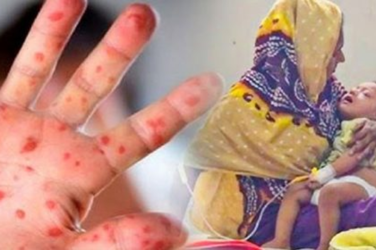 Measles Outbreak Escalates In Cumilla As Infant Dies