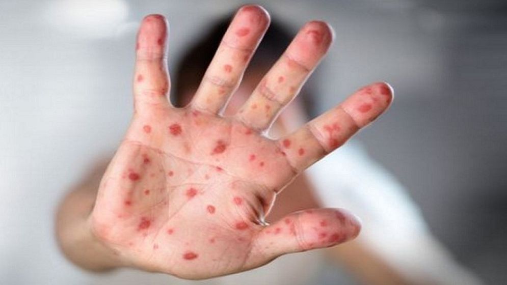Seven Children Die from Measles and Related Symptoms