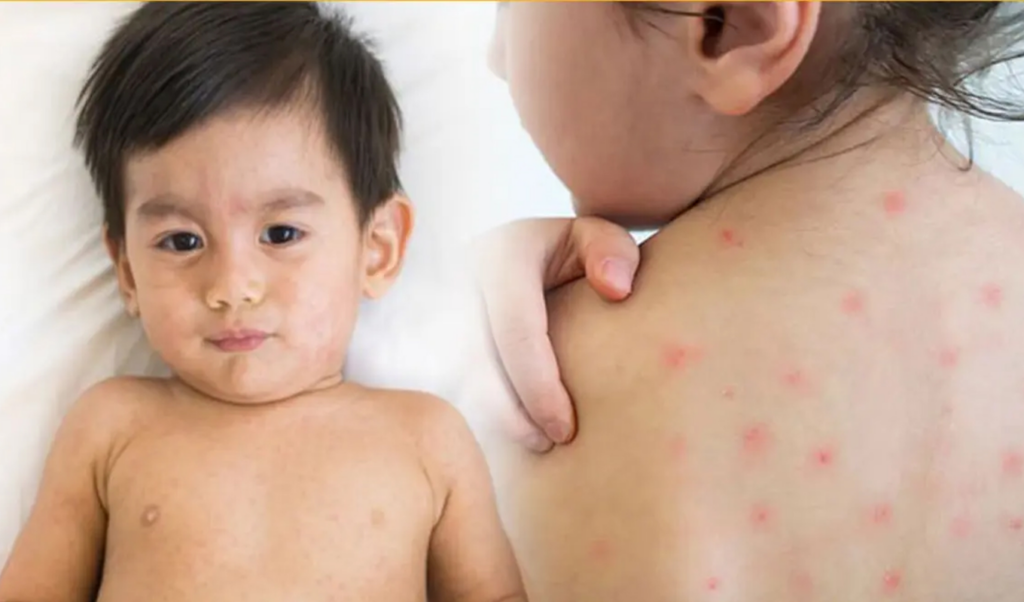 four suspected measles deaths reported in 24 hours Four Suspected Measles Deaths Reported in 24 Hours