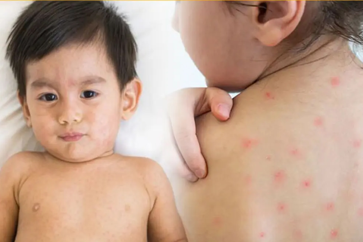 Four Suspected Measles Deaths Reported in 24 Hours