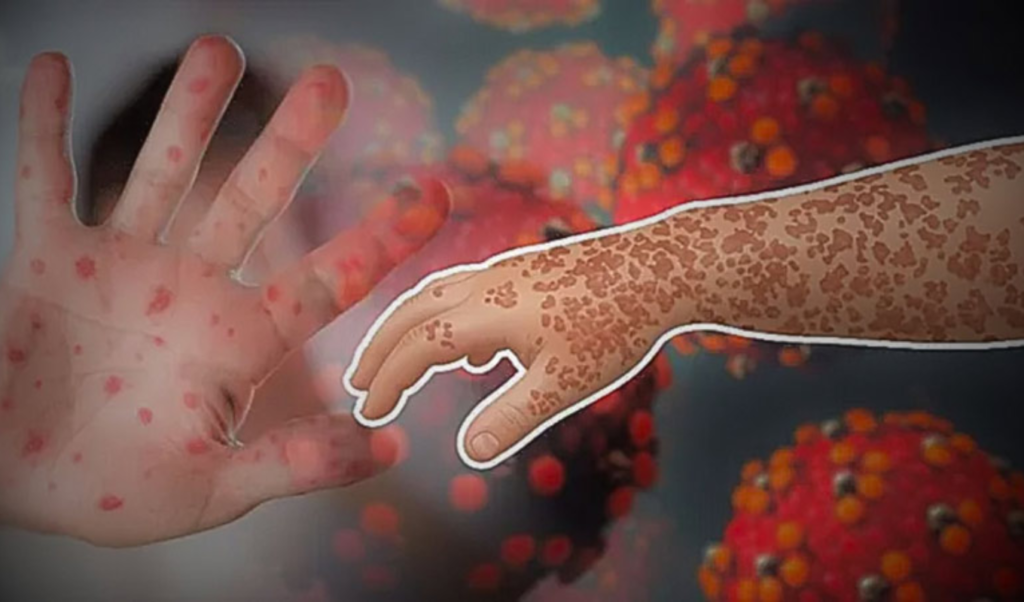Measles Complications Claim More Lives In Bangladesh Hospital Measles Complications Claim More Lives In Bangladesh Hospital