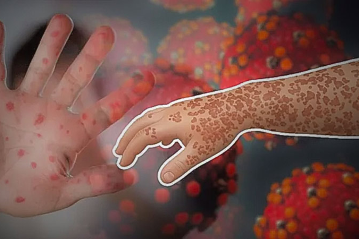 Measles Complications Claim More Lives In Bangladesh Hospital