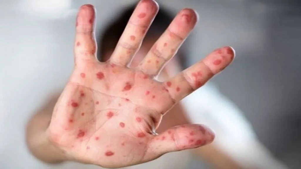 Measles Crisis Deepens Across Sylhet Measles Crisis Deepens Across Sylhet