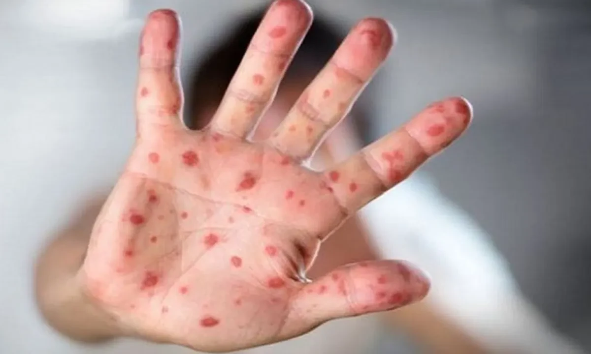 Measles Crisis Deepens Across Sylhet