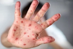 Measles Crisis Deepens Across Sylhet