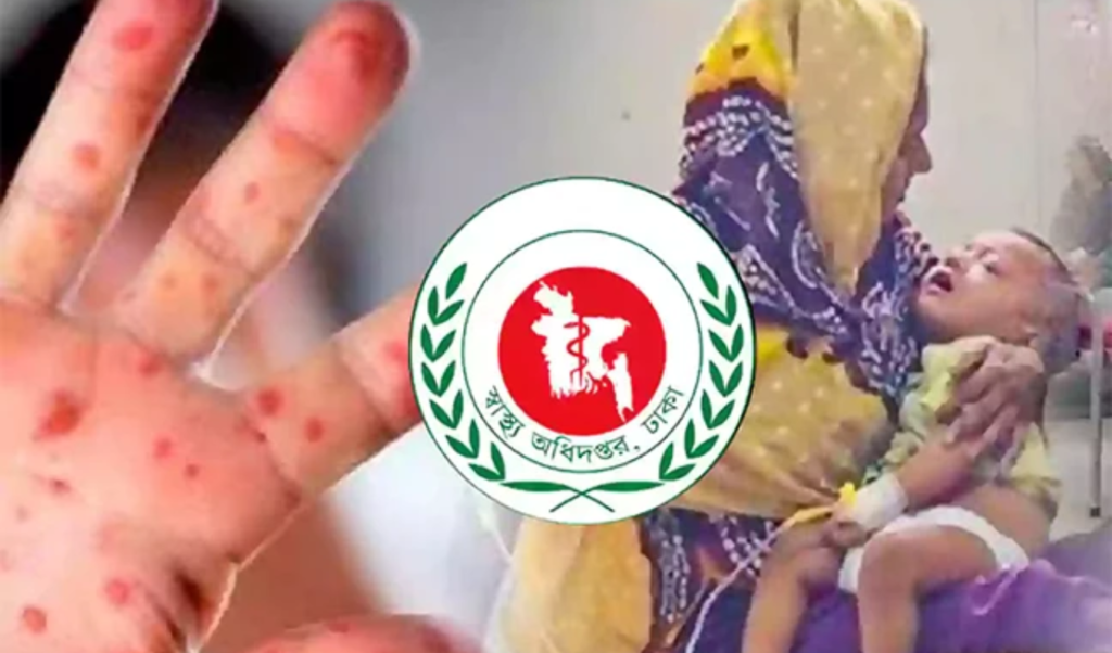 Five die of measles like symptoms as cases pass 96000 Five die of measles-like symptoms as cases pass 96,000