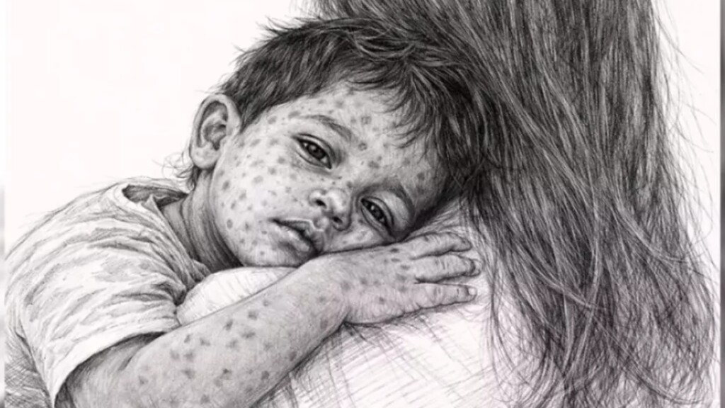 Four More Die With Measles Symptoms Nationwide Four More Die With Measles Symptoms Nationwide