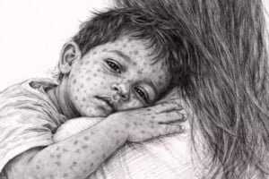 Four More Die With Measles Symptoms Nationwide
