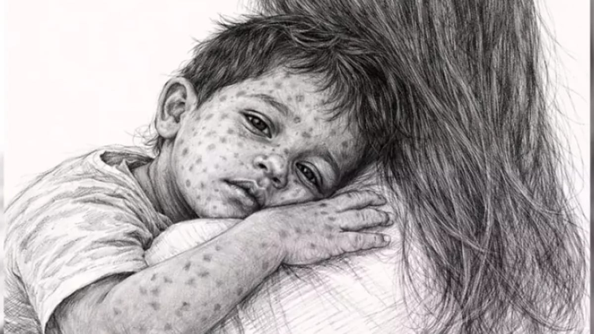 Four More Die With Measles Symptoms Nationwide