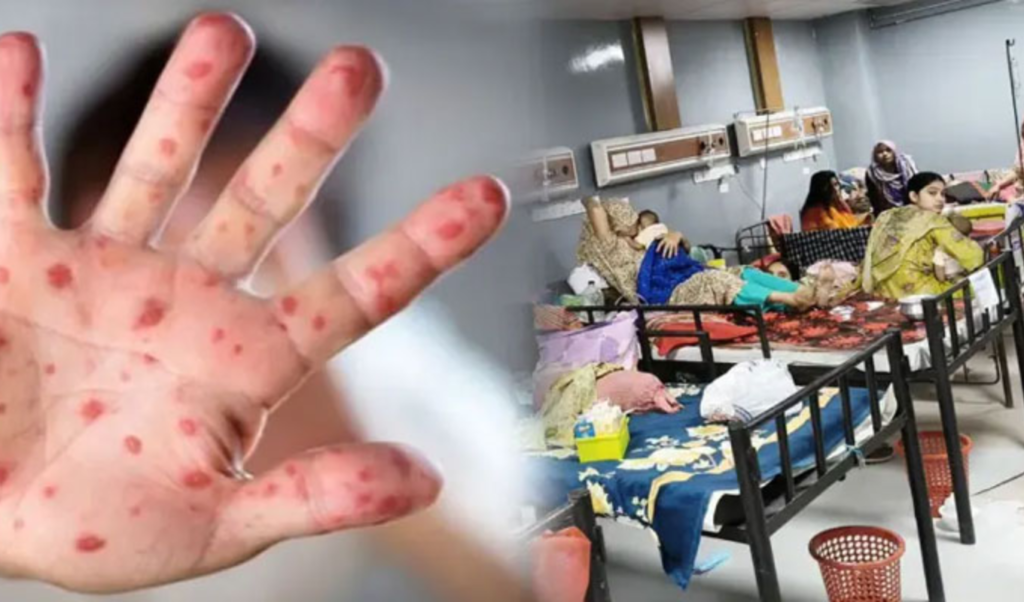 Measles toll rises to 745 in Bangladesh as deaths surge Measles toll rises to 745 in Bangladesh as deaths surge