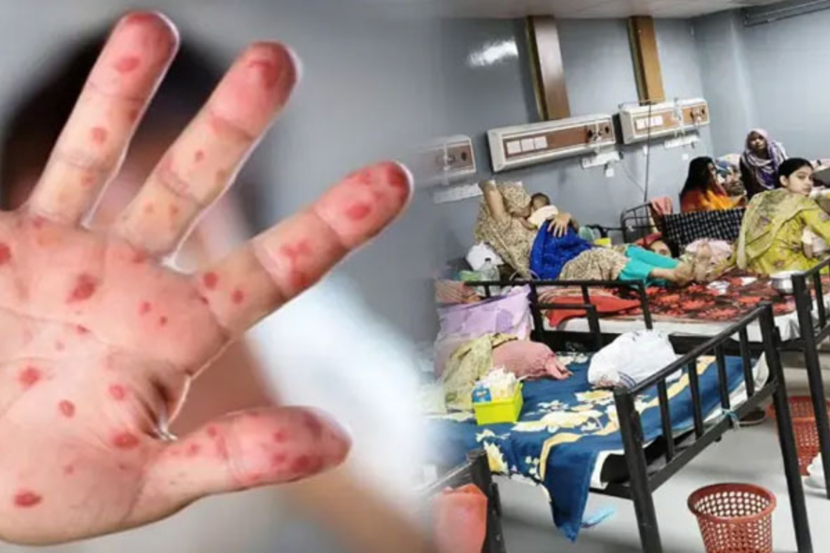 Measles toll rises to 745 in Bangladesh as deaths surge