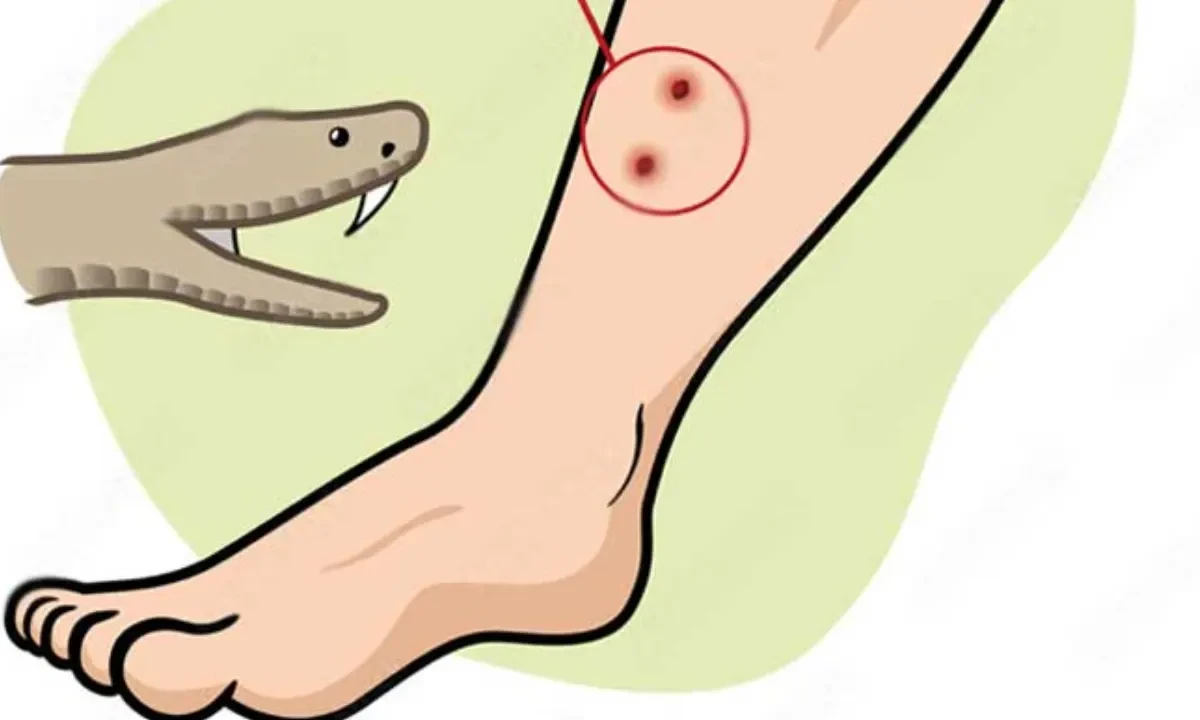 Snakebite Cases Rise to 75 in Flood-Hit Chattogram