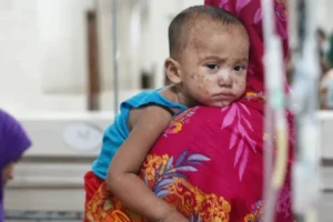 Three More Suspected Measles Deaths Reported Across Bangladesh