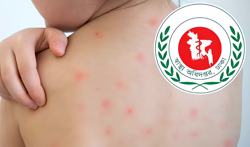 Measles Death Toll Reaches 885 as Five More Succumb Nationwide Measles Death Toll Reaches 885 as Five More Succumb Nationwide