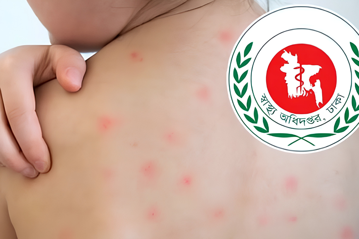Measles Death Toll Reaches 885 as Five More Succumb Nationwide