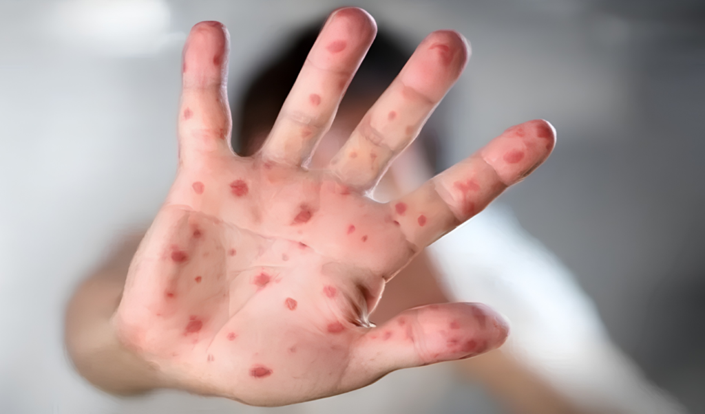 Another Child Succumbs to Measles Outbreak in Mymensingh Hospital 3 Another Child Succumbs to Measles Outbreak in Mymensingh Hospital