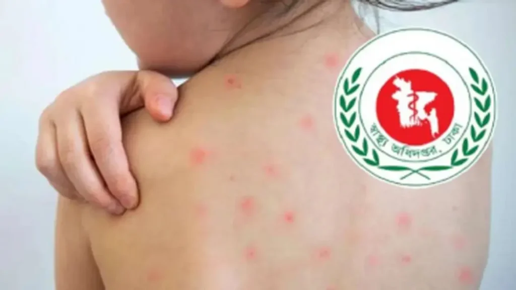 Measles Suspicions Claim Six More Lives as Fatalities Surpass 1,000