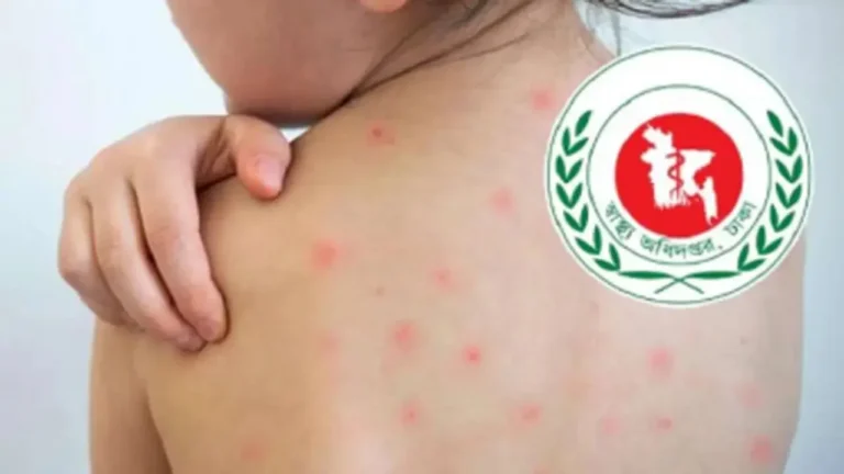 Measles Suspicions Claim Six More Lives as Fatalities Surpass 1,000