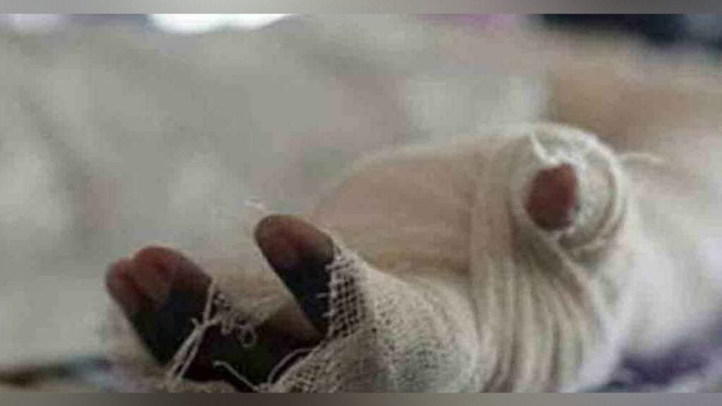 Filipino Tourist Suffers Severe Burns in Dhaka Gas Fire
