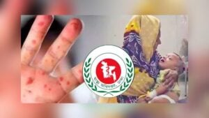 Measles Symptoms Claim Eight More Children’s Lives