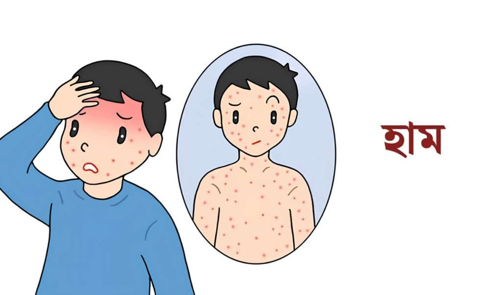Two Infants Die as Measles Outbreak Escalates in Sylhet